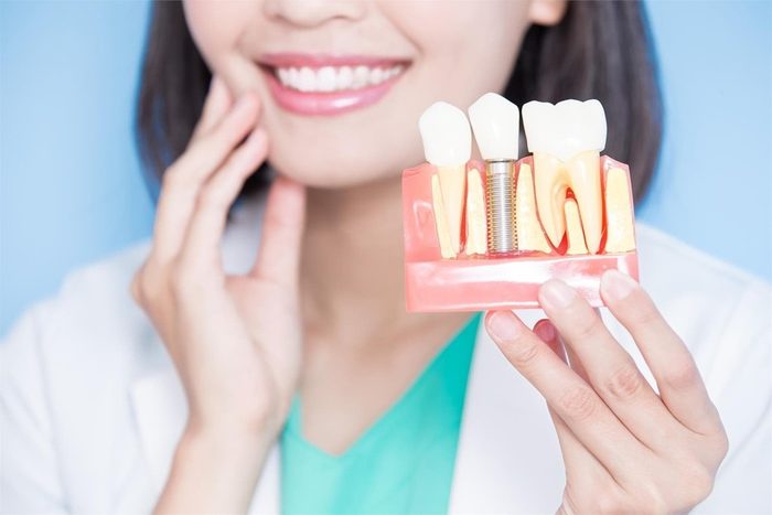 Implantes Dentales