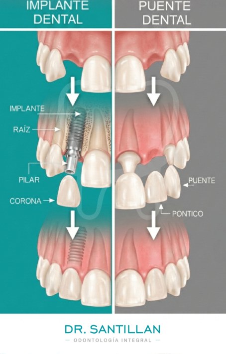Implante dental vs puente dental
