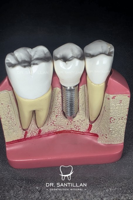 Modelo de implante dental