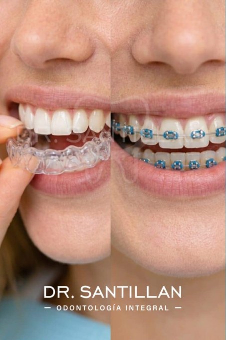 Brackets y alineadores