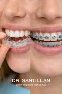 Comparación entre alineadores transparentes y brackets metálicos en tratamiento de ortodoncia para mejorar la sonrisa